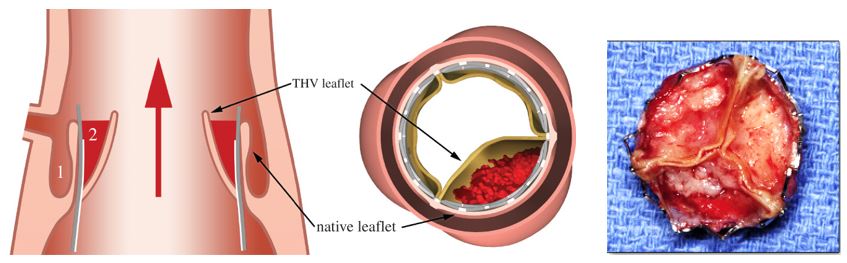 Valve_Thrombosis